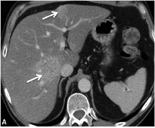 Figure 11 : TDM hépatique en coupe axiale, après injection du produit de contraste au temps  portal, présence de deux lésion secondaires (flèches fines) 