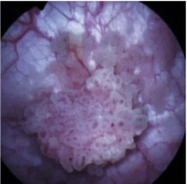 Figure 4 : Vue cystoscopique d’une tumeur de vessie d’allure superficielle papillaire   à frange fine&lt;15mm 
