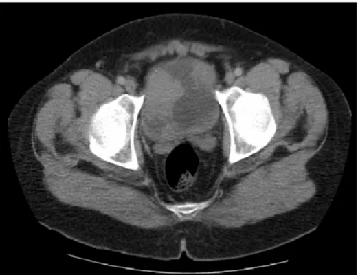 Figure 8 : Tumeur vésicale multifocale  intéressant la paroi latérale droite, la paroi antérieure, et  la paroi postérieure 