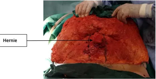 Figure 7 : Une hernie ombilicale avec diastasis. Hernie 