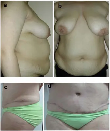Figure  27 :  a-b  photos de  face et de profil d’une patiente âgée de 40 ans, avant  l’abdominoplastie