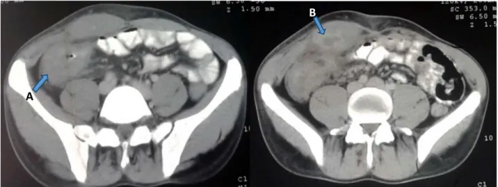 Figure 10 : coupe axiale tomodensitométrique mettant en évidence chez un patient porteur de  MC 