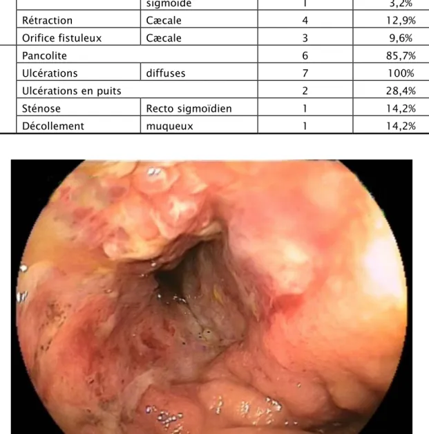 Figure 14: image endoscopique chez un malade atteint de MC montrant une sténose  intestinale 