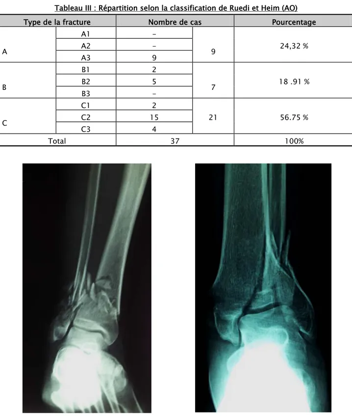 Tableau III : Répartition selon la classification de Ruedi et Heim (AO) 