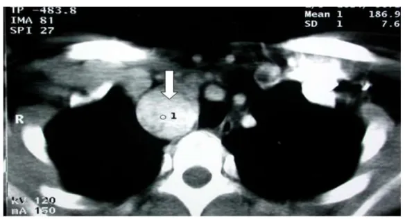 Figure 8a : TDM thoracique montrant la localisation rétro-claviculaire droite   d’une masse de densité tissulaire, faisant suspecter un paragangliome médiastinal  