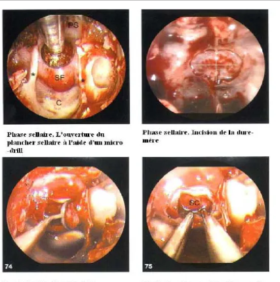 Figure 15 : étapes de la chirurgie endoscopique  endonasale transphénoidale.[22] 