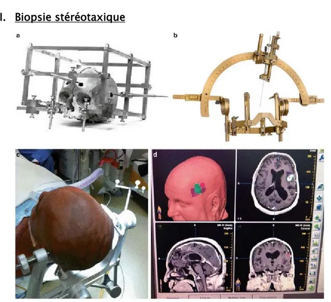 Figure 20: Evolution de la biopsie stéréotaxique de a) Model de Clarck 1906 à b) Cadre de Leskell  (1947) vers c) stéréotaxie sans cadre