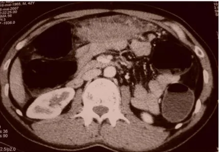 FIGURE  19 : Coupe tomodensitométrique montrant une masse du grand omentum associée à  une distension colique avec stase stercorale (cas n°7)