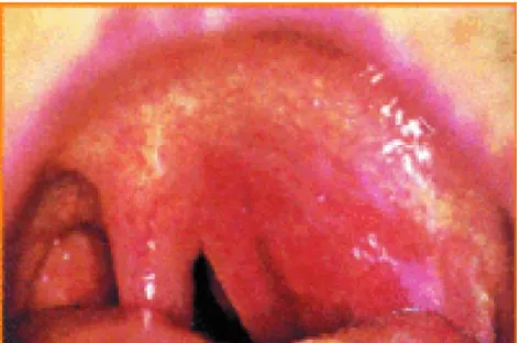 Figure 14 : Aspect de l’oropharynx lors d’un phlegmon périamygdalien [2] 