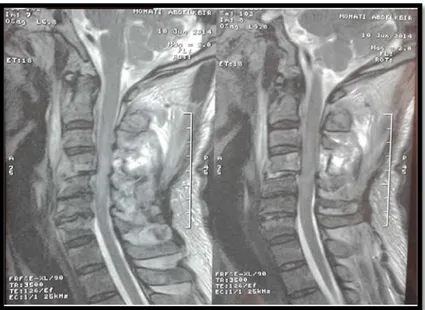 Figure 1 : IRM cervicale en coupe sagittale , séquence pondérée T2 montrant une luxation C4-C5  avec contusion médullaire étendu de C2 à C6 