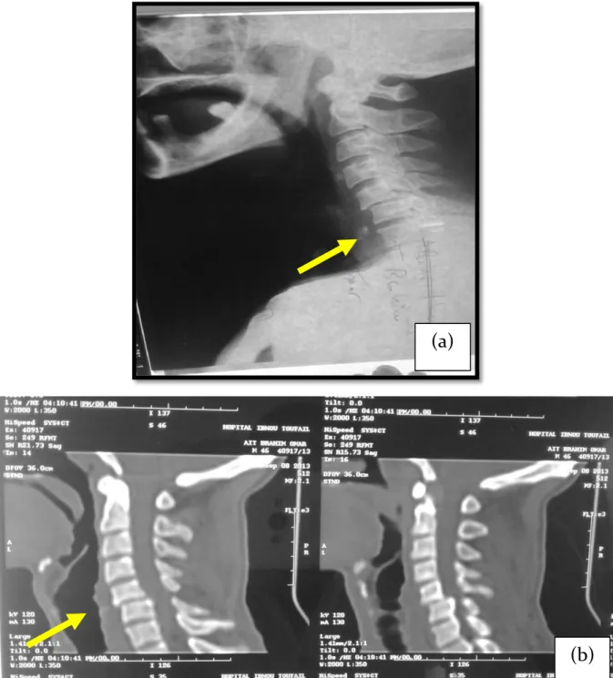 Figure 3 : Radiographie standard (a) et TDM  (b) en coupe sagittale du rachis cervical montrant  une luxation C5-C6.