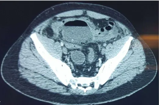 Figure N°13 :  Aspect scannogaphique d’un plastron appendiculaire abcédé   chez un patient de notre série