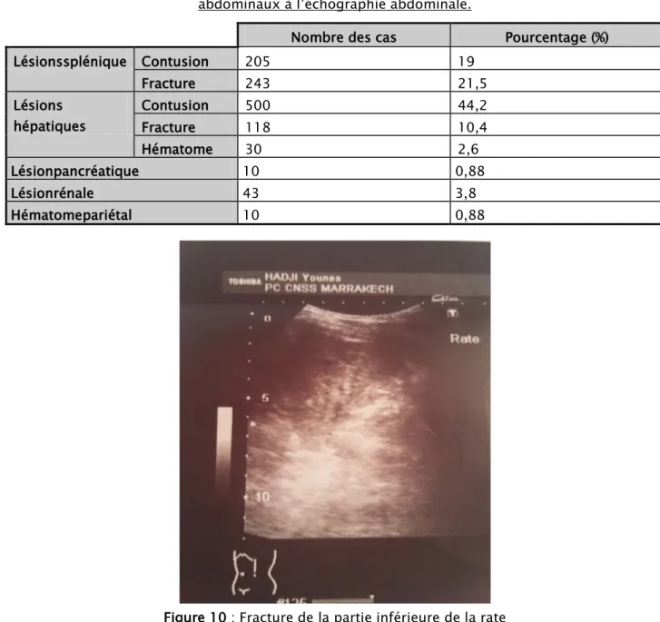 Tableau V : Les différentes lésions viscérales au cours des Traumatismes  abdominaux à l’échographie abdominale
