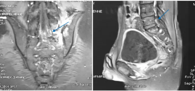 Figure 31 :IRM pelvienne:sarcome d’Ewing sacré  des 3 premières vertèbres sacrés  en hypersignal en T2 avec envahissement endocanalaire(flèche) et des PM 