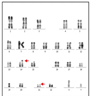 Figure 4 :  Trisomie 21par translocation  robertsonienne entre deux chromosomes 21 