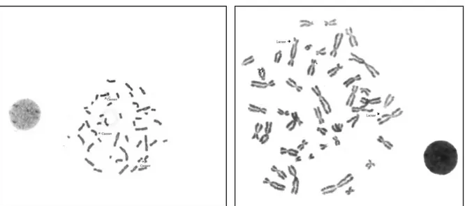 Figure 10 : Présence de cassures et de lacunes témoignant d’une instabilité chromosomique  chez une fille ayant une anémie de Fanconi.