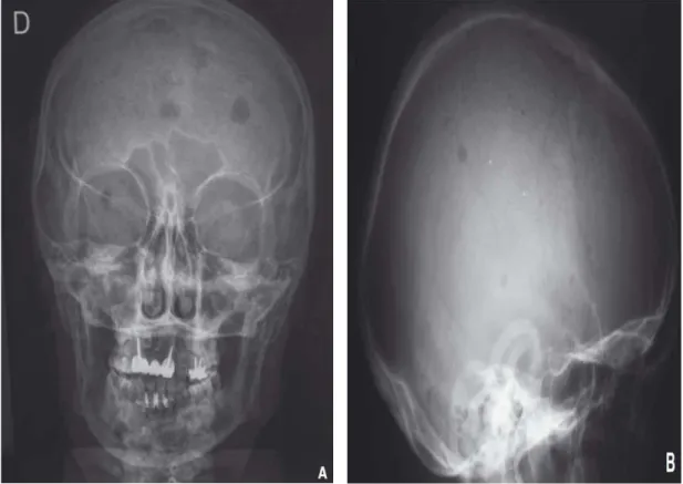 Figure 18 : Radiographie de crâne de face (A) et de profil (B) : Multiples géodes à l’emporte pièce  sans liseré condensant en rapport avec des lésions myélomateuses multiples