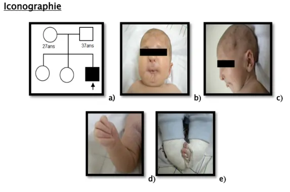 Figure 1 : Syndrome de Freeman Sheldon 