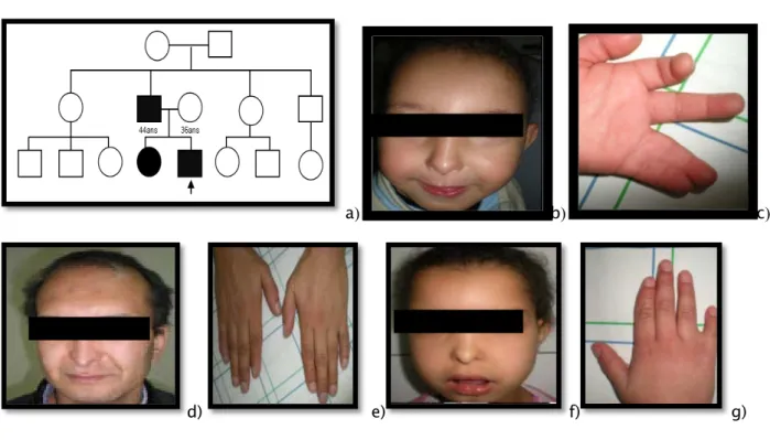 Figure 4 : Syndrome oculo-dento-digital 