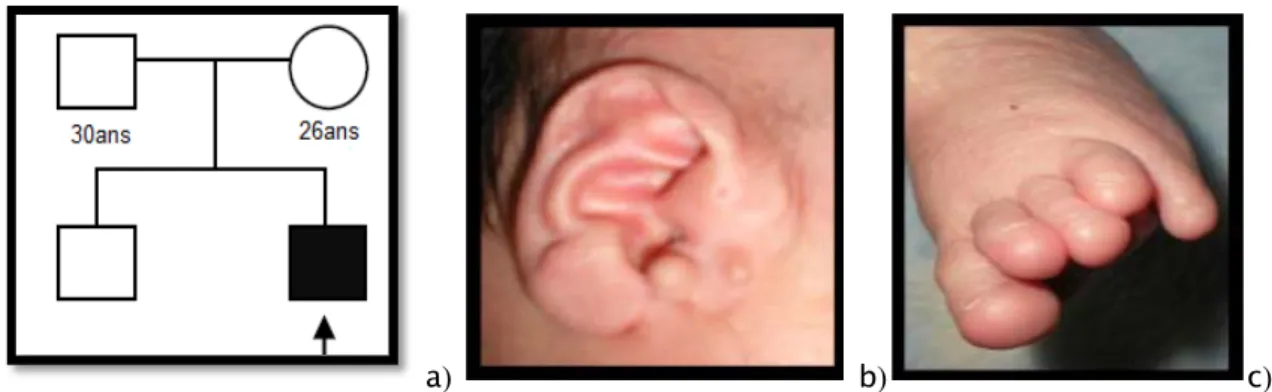 Figure 6 : Syndrome de Townes bockes 