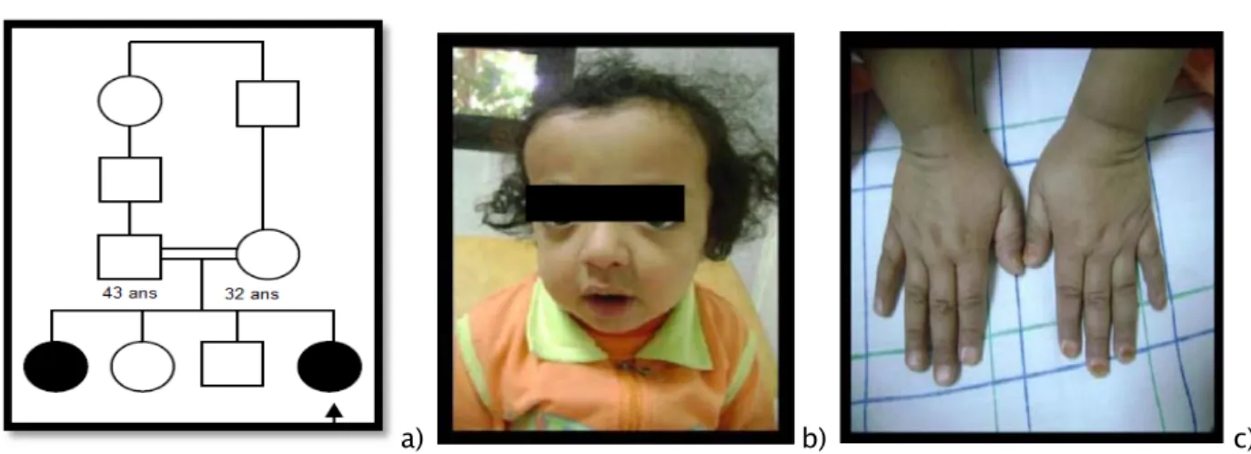 Figure 9 : Pycnodystose familiale 
