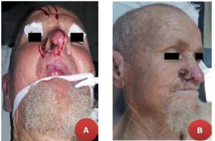 Fig. 6 : A-B : Carcinome basocellulaire de l’aile du nez droite 