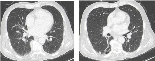 Figure 6 : Coupe tomodensitométrique axiale en fenêtre parenchymateuse chez un homme de 66  ans