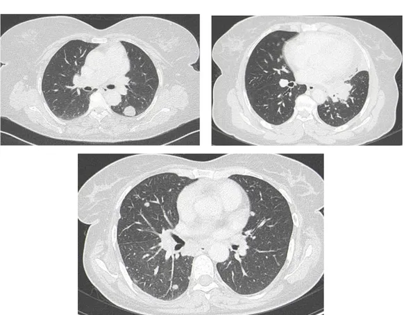 Figure 16 : Coupe tomodensitométrique axiale en fenêtre parenchymateuse.  Métastases  pulmonaires micro et macronodulaires du cancer du col utérin.