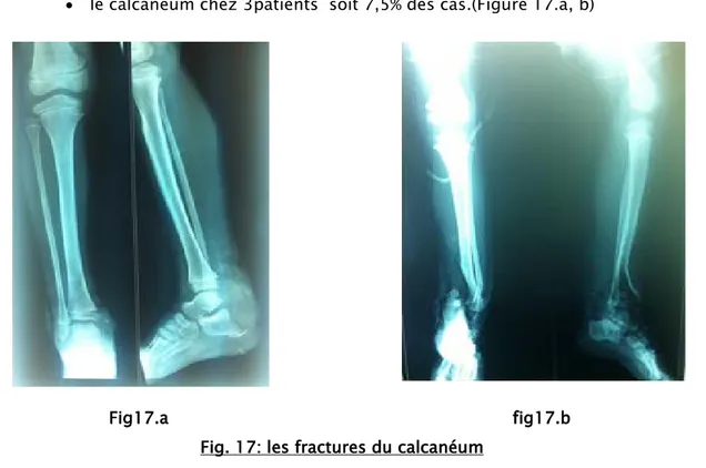 Fig. 17: les fractures du calcanéum 