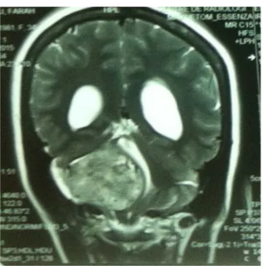 Figure 6. IRM cérébrale en coupe coronale séquence T2 montrant un processus   expansif de l’angle pontocérébelleux  droit hyperintense avec effet de masse 