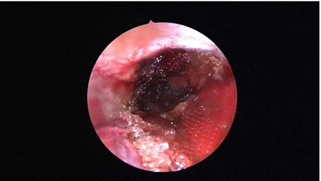 Figure 17. Cavité résiduelle après exérèse tumorale totale   et réalisation de l’hémostase à la surgicel 