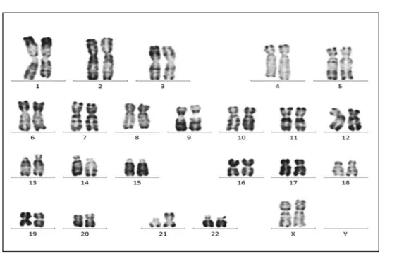 Figure 11:  Trisomie 21 par translocation (21;21) : 46,XX,t(21;21)(q10;q10),+21 