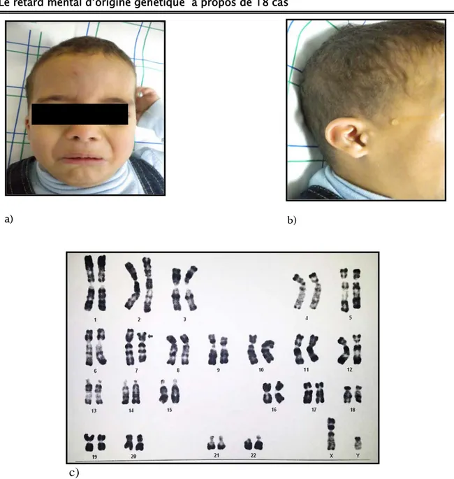 Figure 5:  Délétion du bras court du chromosome 7 chez un garçon  a.  Dysmorphie faciale 