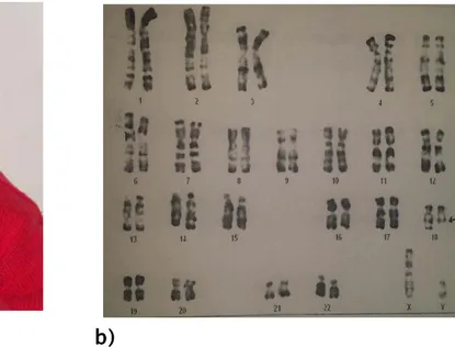 Figure 7 :  Délétion terminale du bras long du chromosome 18 
