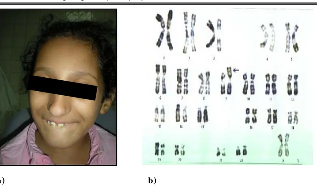 Figure 8 :  Dérivé du chromosome 9 chez une fille  a)   Dysmorphie faciale 