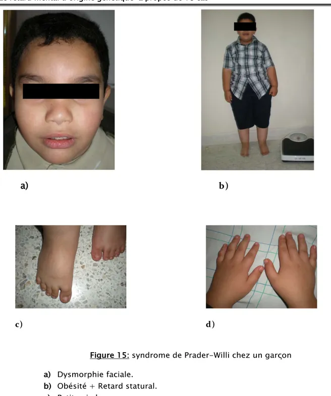 Figure 15:  syndrome de Prader-Willi chez un garçon  a)  Dysmorphie faciale. 
