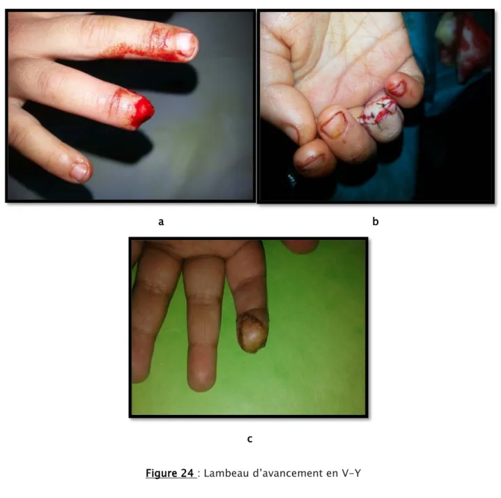 Figure 24  :  Lambeau d’avancement en V-Y 