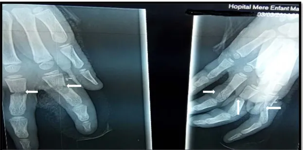 Figure 29 : fractures diaphysaires ouvertes des 2 e , 3 e  et 4 e
