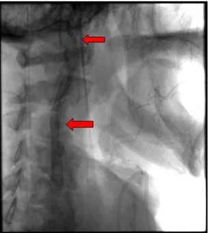 Figure 18: Image de  per-procédure qui objective le largage du stent carotidien 7/40mm avec le  système de filtre carotidien