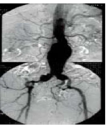 Figure 30: Image d'artériographie montrant un anévrysme de l’aorte abdominale   sous rénale étendu aux deux artères iliaques 