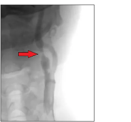 Figure 34: Image d'artériographie qui montre une sténose serrée à plus de 75 % de l’ACI gauche 