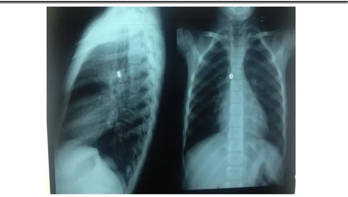 Figure 7 : Radiographie thoracique de face et profil montrant un CE métallique de la bronche  souche droite