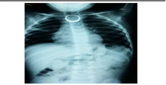 Figure 17 : Radiographie thoracique de face montrant un CE de l’oesophage cervical (bague)