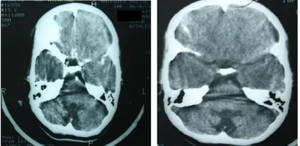 Figure 11: TDM Cérébrale coupe axiale C- montrant une atrophie vermienne   chez  une fille de 10 ans présentant une ataxie télangiectasie 