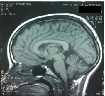 Figure 14:IRM encéphalique coupe sagittale en T1  montrant Une atrophie bulbo spinale   chez une femme de 21 ans présentant une ataxie par déficit en vitamine E 