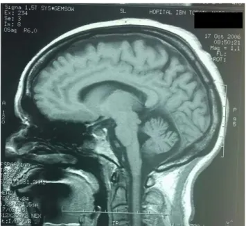 Figure 15 : IRM cérébrale coupe sagittale en T1normale   chez une femme présentant Une ataxie de Friedreich 