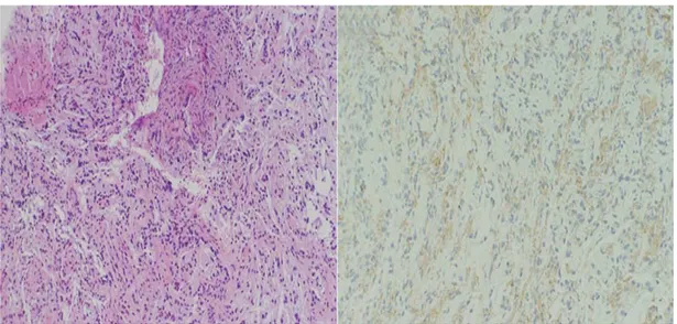 Figure 8: coupes anatomopathologiques avec étude immunohistochimique montrant un aspect  dense des cellules gliales en faveur d’un astrocytome pilocytique