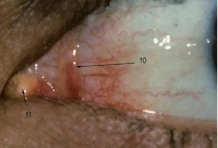 Figure 4: photo de l’angle nasal de l’œil montrant : 10-plis semi-lunaire. 11-caroncule