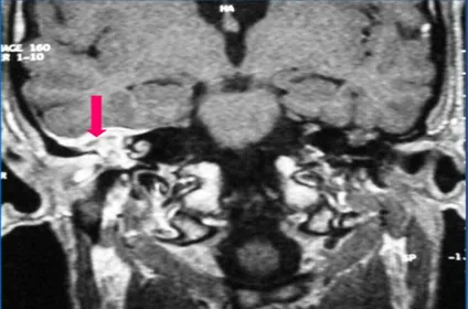 Figure 18 : IRM coupe coronale T1 GADO : comblement de l’oreille moyenne avec lyse du tegmen 