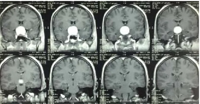 Figure 4 : IRM cérébrale en coupe coronale T2 flair objectivant un macroadénome sellaire à  double composante kystique et charnue 